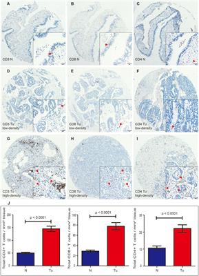 Nomograms to Predict the Density of Tumor-Infiltrating Lymphocytes in Patients With High-Grade Serous Ovarian Cancer